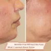 Wrinkle-Free Botox