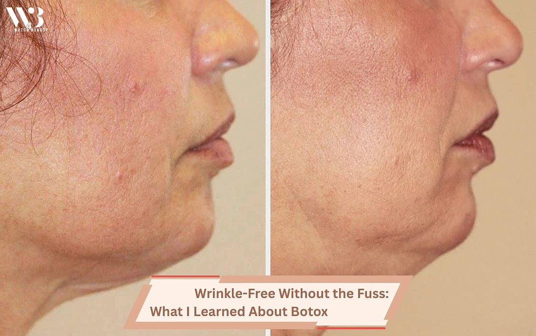 Wrinkle-Free Botox