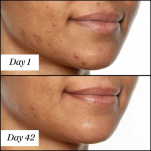 Salicylic Acid BHA Acne Treatment Face Oil
